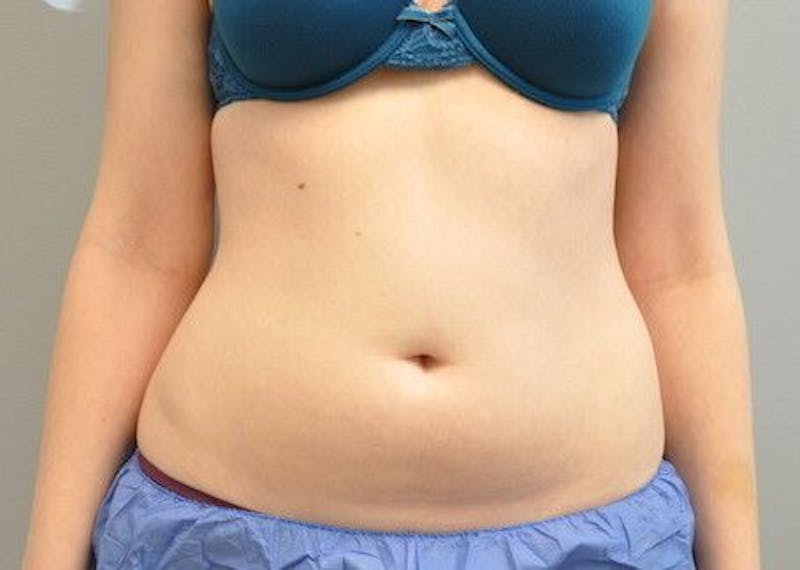 CoolSculpting Before & After Gallery - Patient 55344961 - Image 1