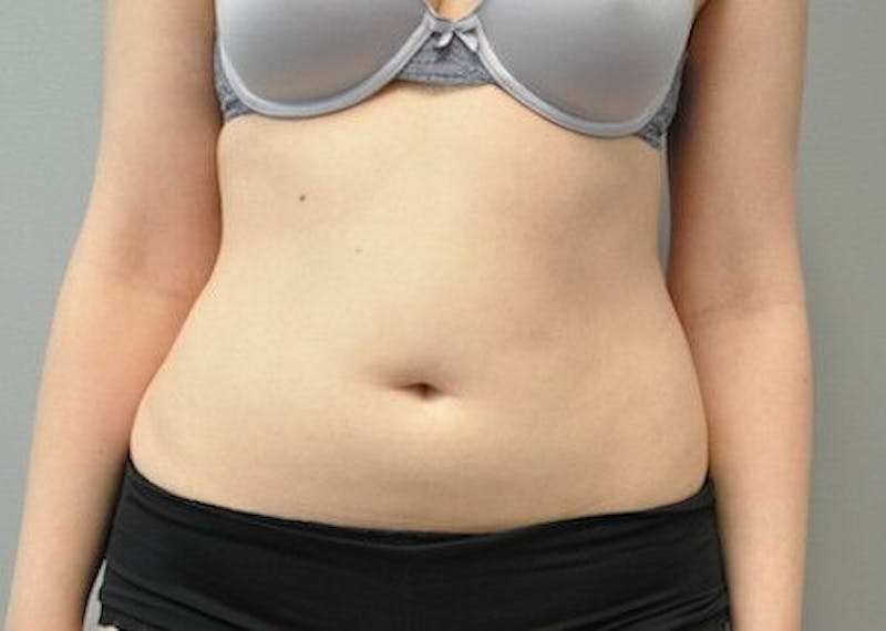 CoolSculpting Before & After Gallery - Patient 55344961 - Image 2