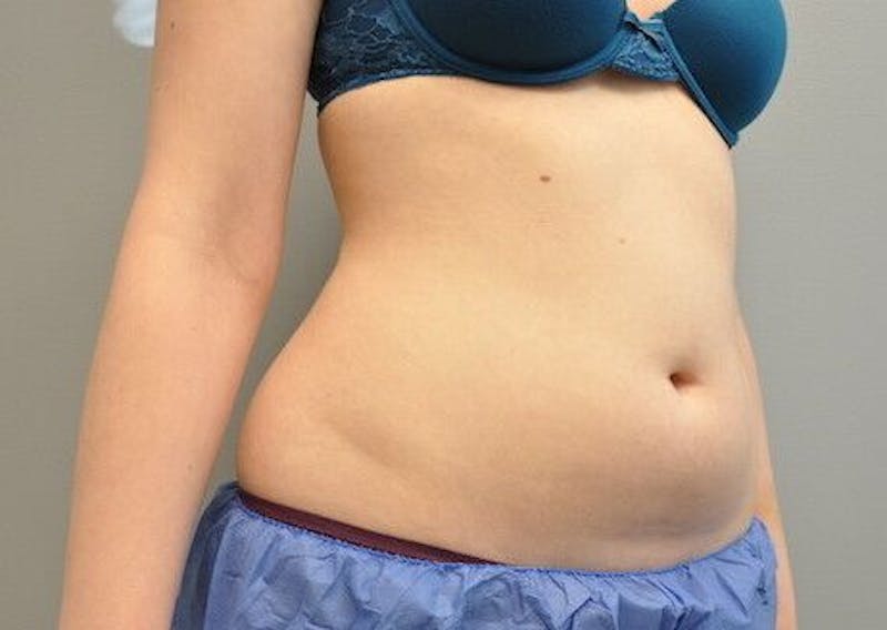 CoolSculpting Before & After Gallery - Patient 55344961 - Image 3