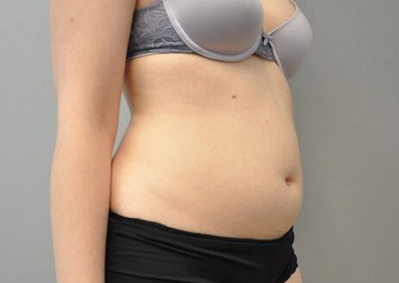 CoolSculpting Before & After Gallery - Patient 55344961 - Image 4