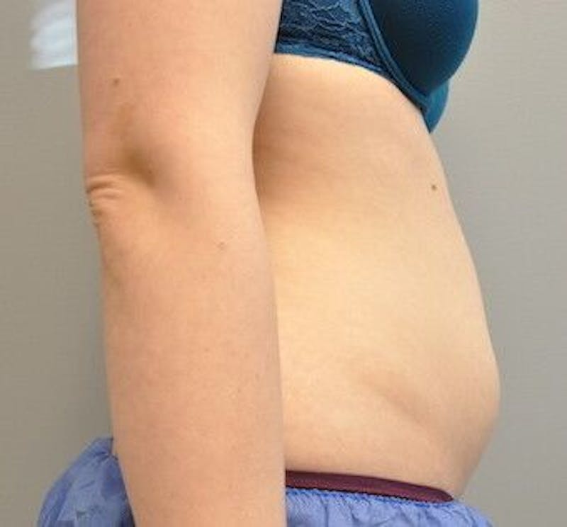 CoolSculpting Before & After Gallery - Patient 55344961 - Image 5