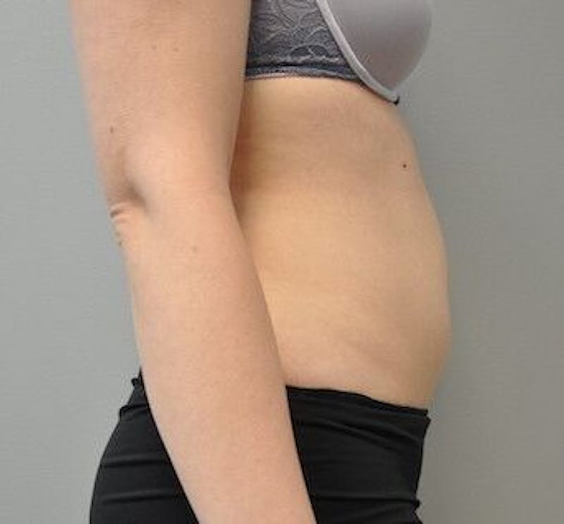 CoolSculpting Before & After Gallery - Patient 55344961 - Image 6