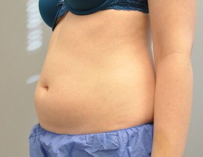 CoolSculpting Before & After Gallery - Patient 55344961 - Image 7