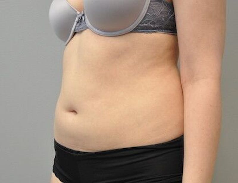 CoolSculpting Before & After Gallery - Patient 55344961 - Image 8