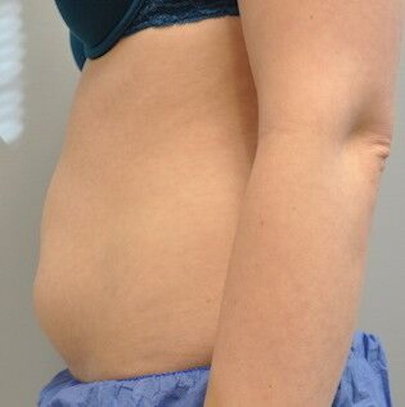 CoolSculpting Before & After Gallery - Patient 55344961 - Image 9