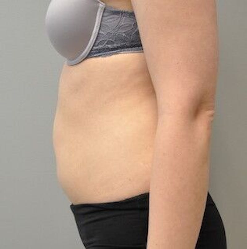 CoolSculpting Before & After Gallery - Patient 55344961 - Image 10
