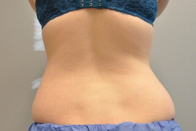 CoolSculpting Before & After Gallery - Patient 55344961 - Image 11