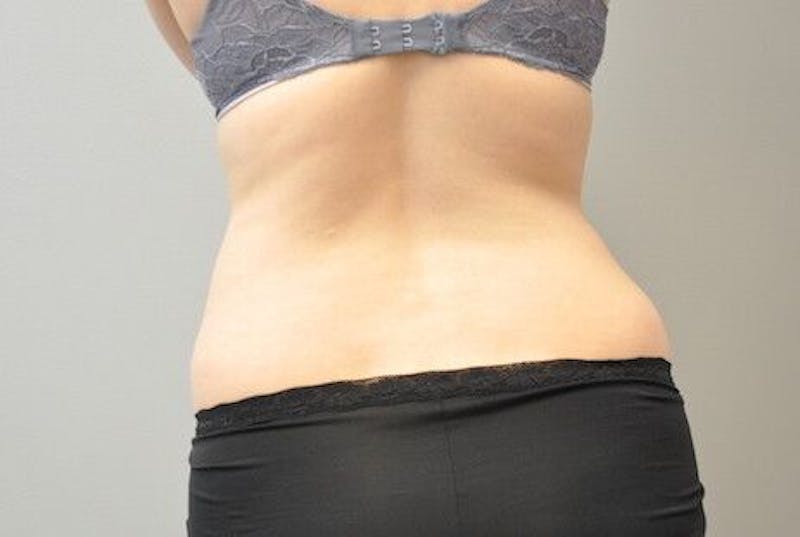 CoolSculpting Before & After Gallery - Patient 55344961 - Image 12
