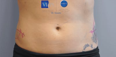 CoolSculpting Before & After Gallery - Patient 55344973 - Image 1