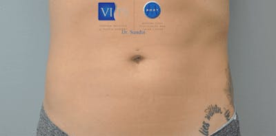 CoolSculpting Before & After Gallery - Patient 55344973 - Image 2