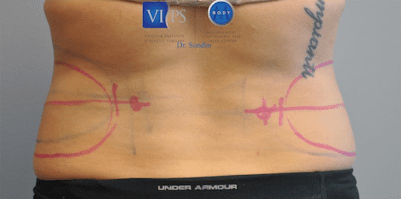 CoolSculpting Before & After Gallery - Patient 55344973 - Image 3