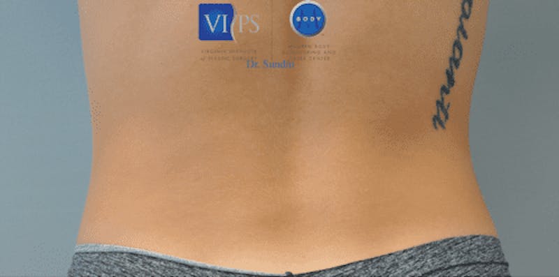 CoolSculpting Before & After Gallery - Patient 55344973 - Image 4
