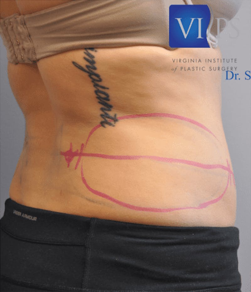 CoolSculpting Before & After Gallery - Patient 55344973 - Image 5