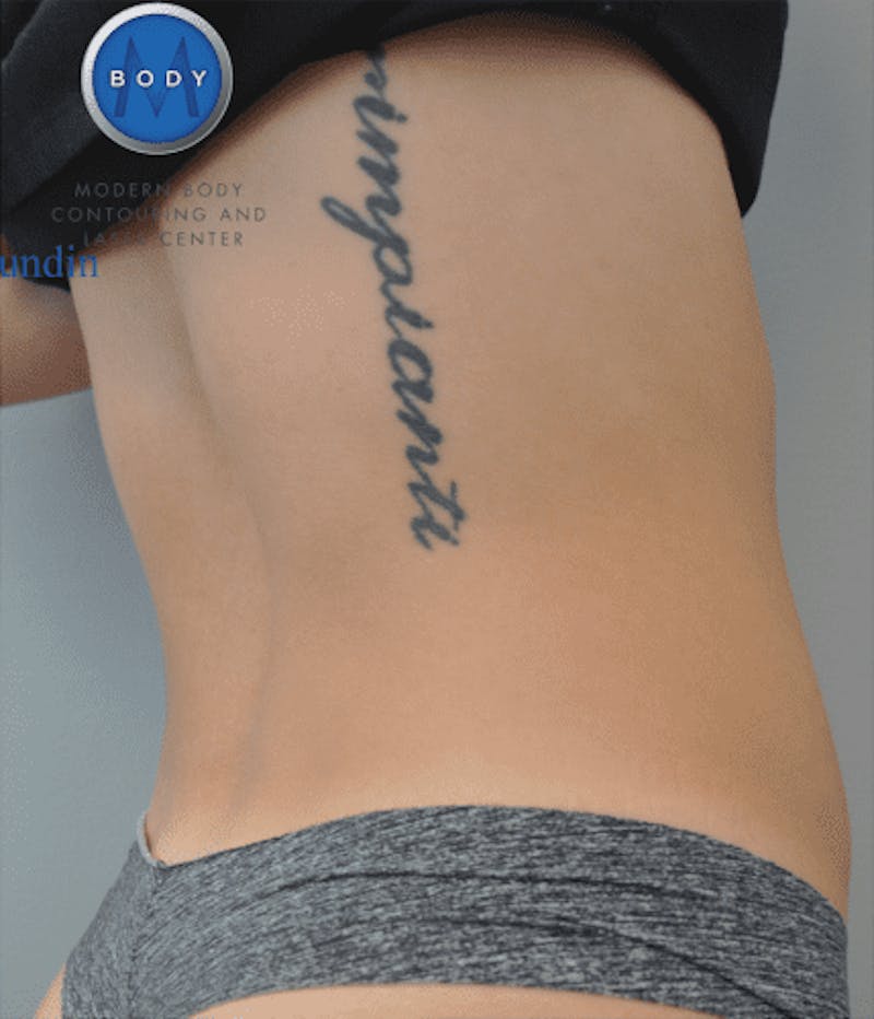 CoolSculpting Before & After Gallery - Patient 55344973 - Image 6