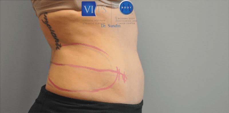 CoolSculpting Before & After Gallery - Patient 55344973 - Image 7