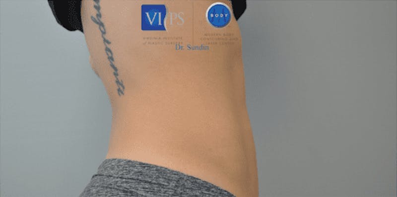CoolSculpting Before & After Gallery - Patient 55344973 - Image 8