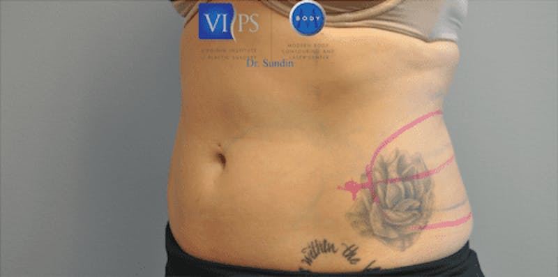CoolSculpting Before & After Gallery - Patient 55344973 - Image 9