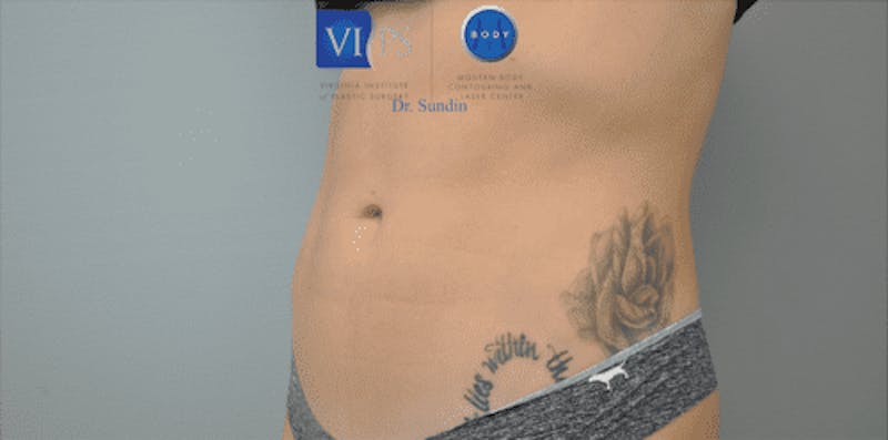 CoolSculpting Before & After Gallery - Patient 55344973 - Image 10