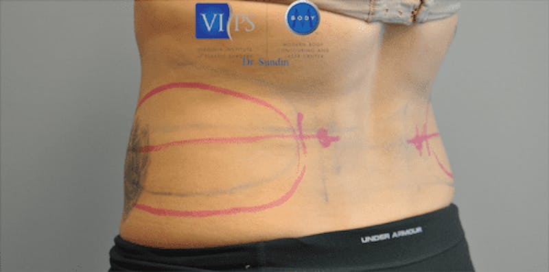 CoolSculpting Before & After Gallery - Patient 55344973 - Image 11