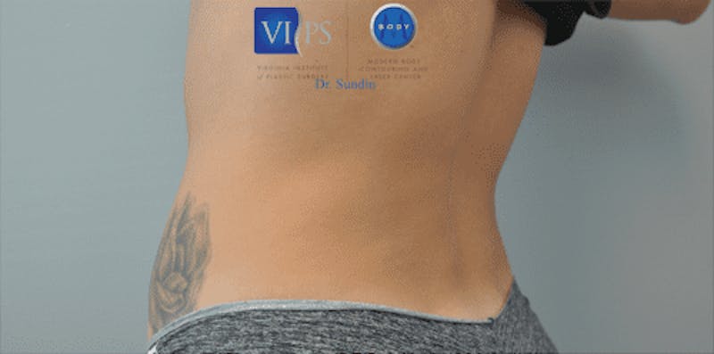 CoolSculpting Before & After Gallery - Patient 55344973 - Image 12