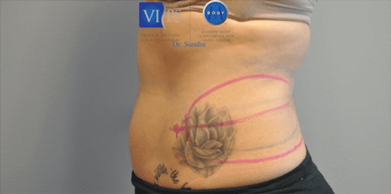 CoolSculpting Before & After Gallery - Patient 55344973 - Image 13