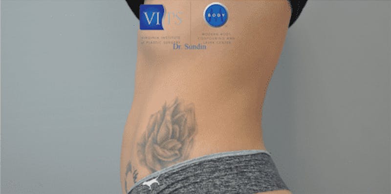 CoolSculpting Before & After Gallery - Patient 55344973 - Image 14