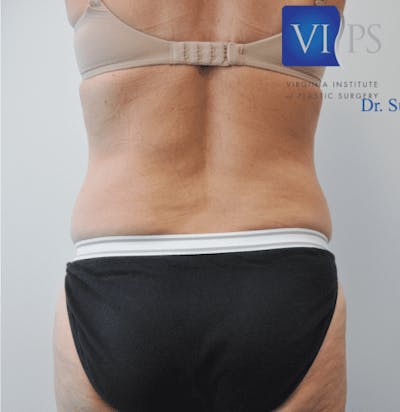 CoolSculpting Before & After Gallery - Patient 55344974 - Image 1