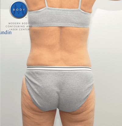 CoolSculpting Before & After Gallery - Patient 55344974 - Image 2
