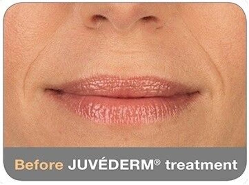 Juvederm Before & After Gallery - Patient 55345044 - Image 1