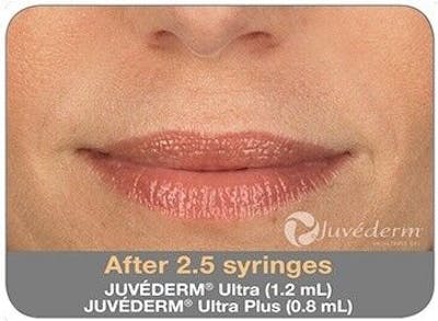 Juvederm Before & After Gallery - Patient 55345044 - Image 2