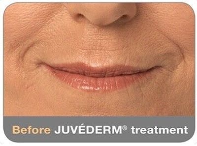 Juvederm Before & After Gallery - Patient 55345046 - Image 1