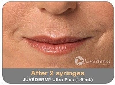 Juvederm Before & After Gallery - Patient 55345046 - Image 2