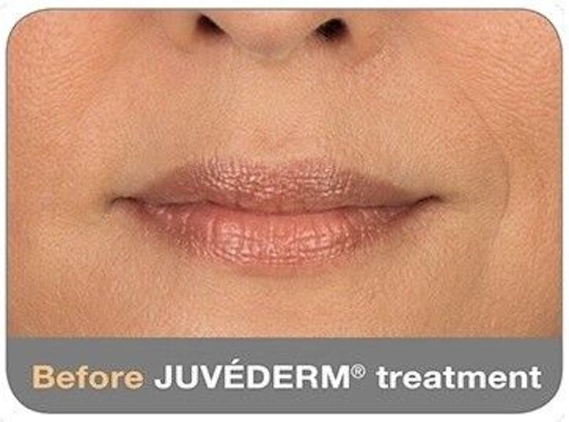 Juvederm Before & After Gallery - Patient 55345047 - Image 1