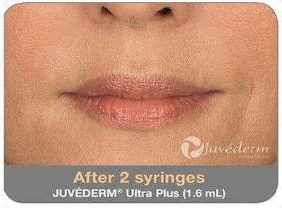 Juvederm Before & After Gallery - Patient 55345047 - Image 2