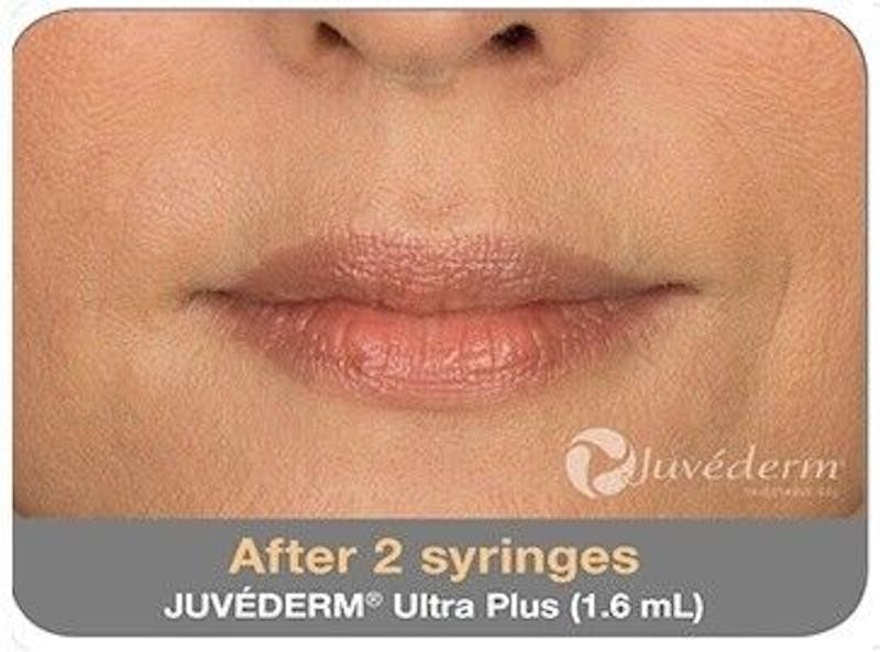 Juvederm Before & After Gallery - Patient 55345047 - Image 2