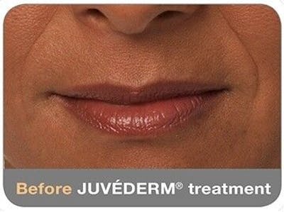 Juvederm Gallery - Patient 55345049 - Image 1