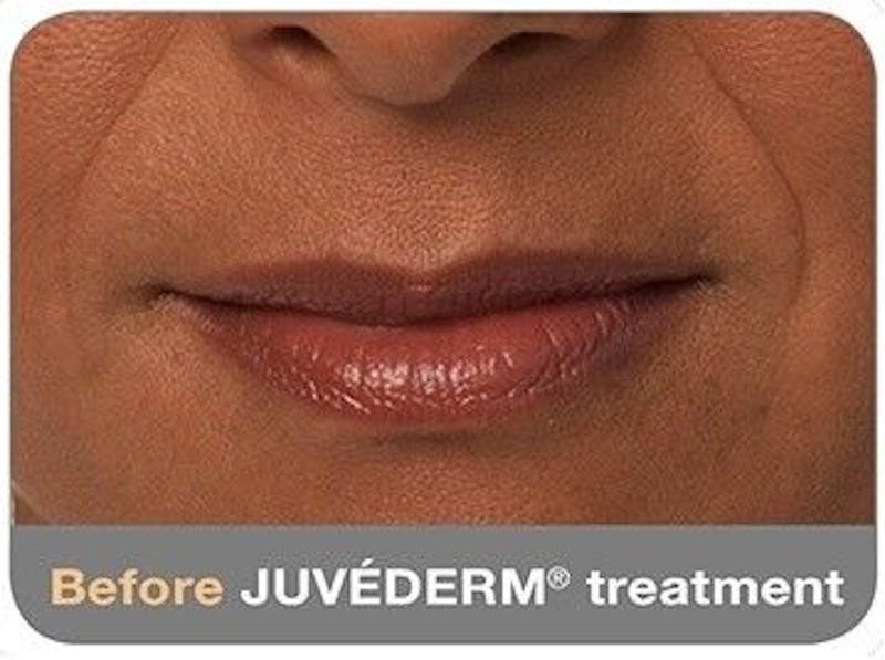 Juvederm Before & After Gallery - Patient 55345049 - Image 1