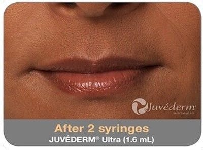 Juvederm Before & After Gallery - Patient 55345049 - Image 2