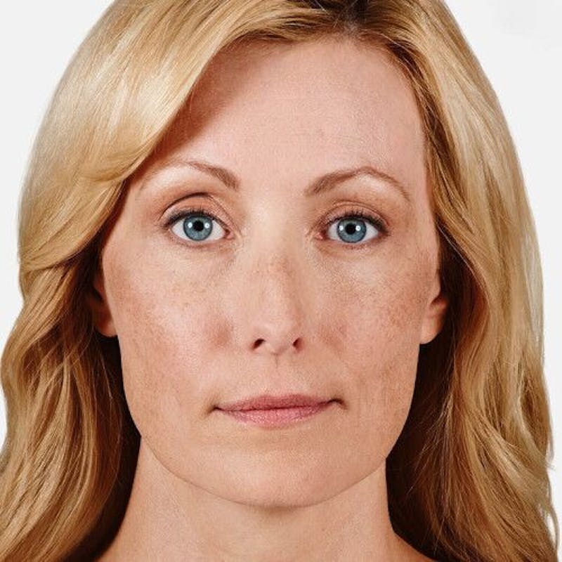 Juvederm Before & After Gallery - Patient 55345054 - Image 1