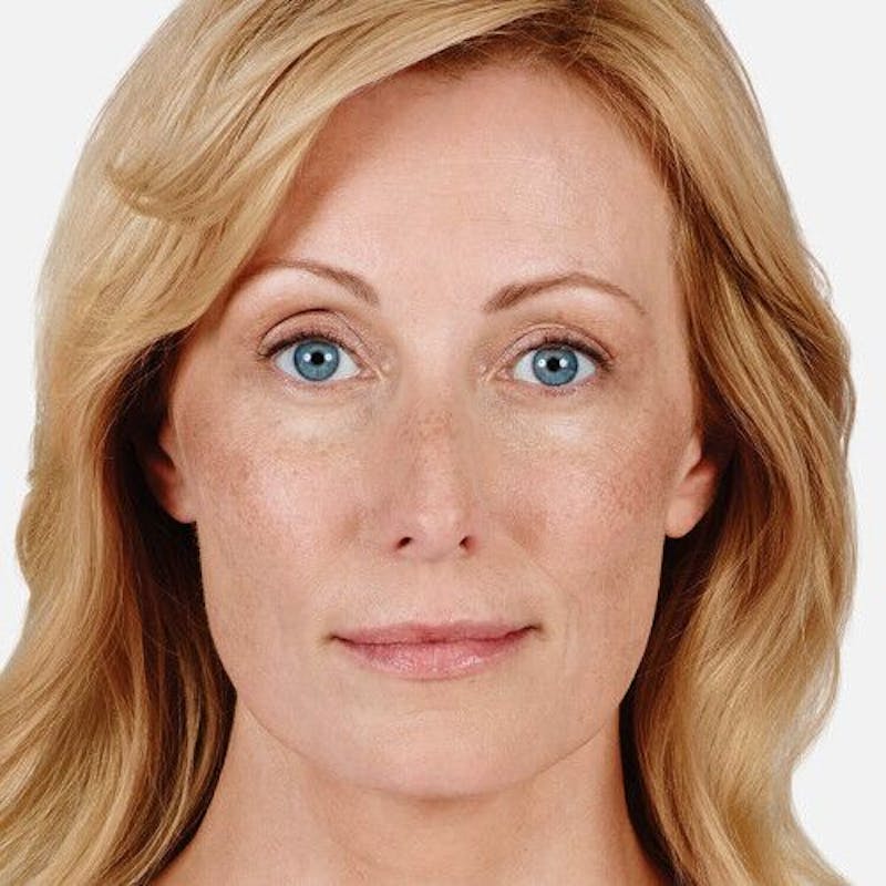 Juvederm Before & After Gallery - Patient 55345054 - Image 2
