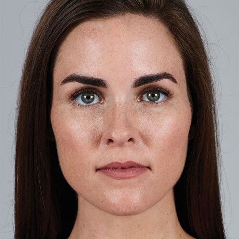 Juvederm Before & After Gallery - Patient 55345055 - Image 1