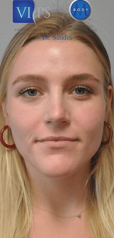 Juvederm Before & After Gallery - Patient 55345063 - Image 1