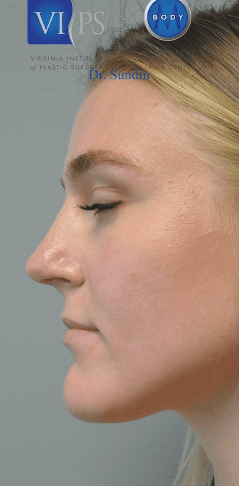 Juvederm Before & After Gallery - Patient 55345063 - Image 5