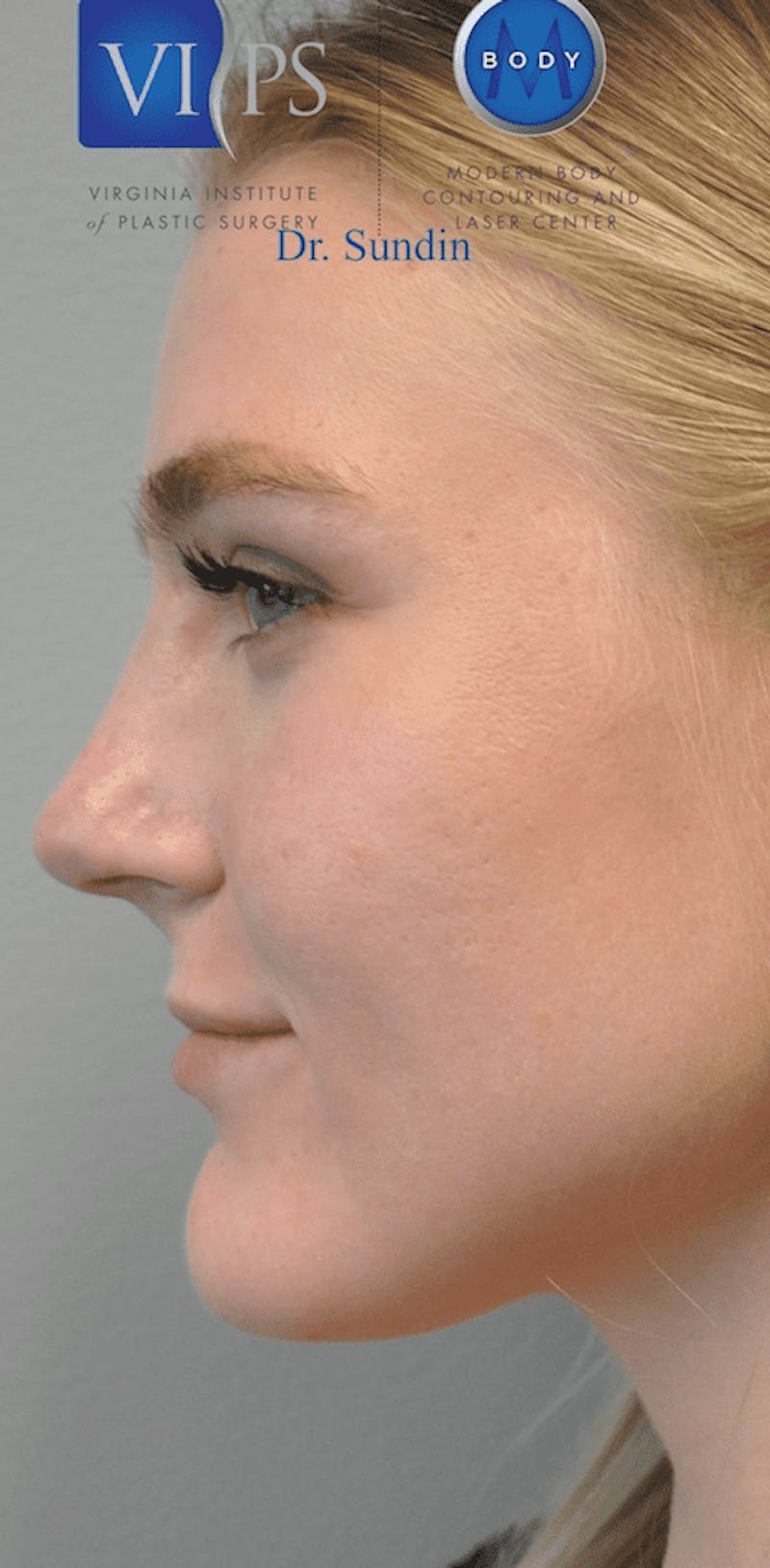 Juvederm Before & After Gallery - Patient 55345063 - Image 6