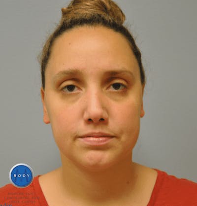 JPlasma Before & After Gallery - Patient 55345074 - Image 2