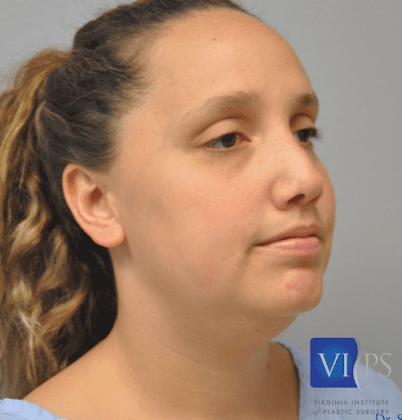 JPlasma Before & After Gallery - Patient 55345074 - Image 3