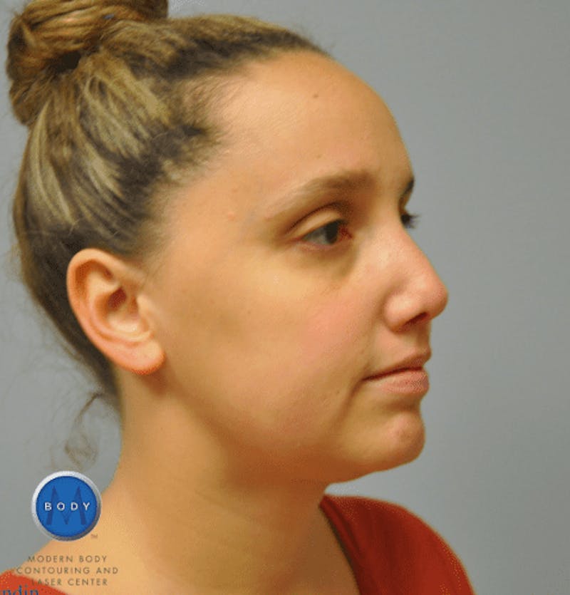 JPlasma Before & After Gallery - Patient 55345074 - Image 4