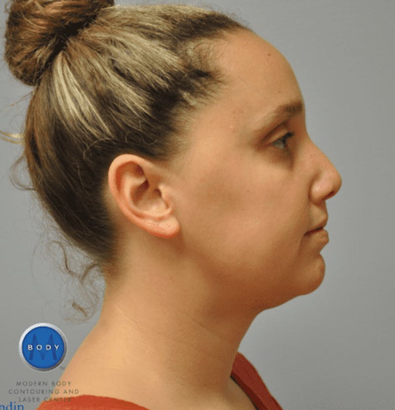 JPlasma Before & After Gallery - Patient 55345074 - Image 6