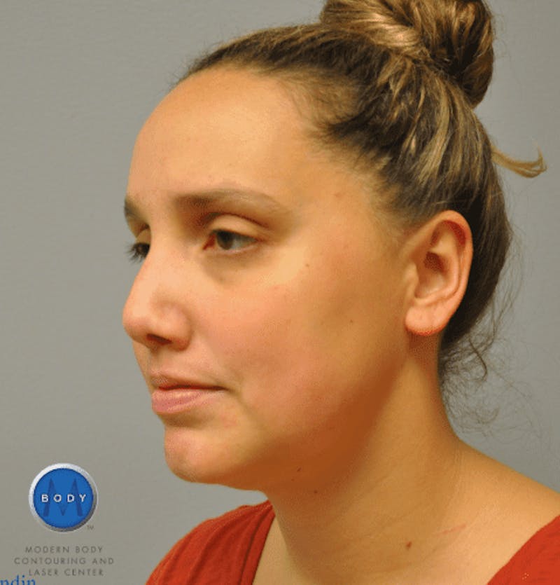 JPlasma Before & After Gallery - Patient 55345074 - Image 8
