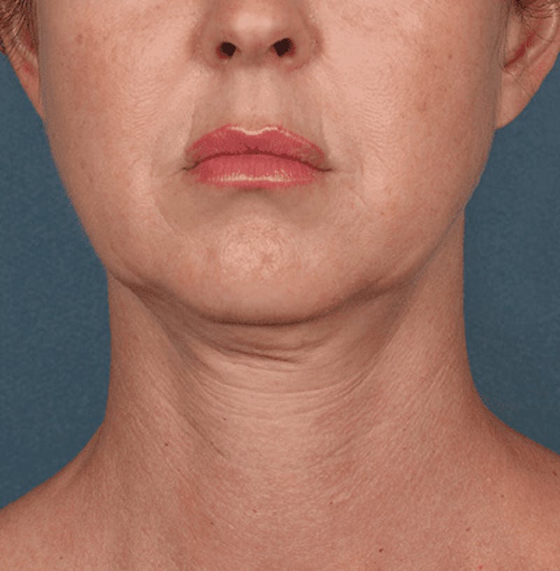 Kybella Before & After Gallery - Patient 55345075 - Image 1